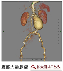 腹部大動脈瘤　イメージ