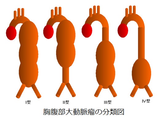 この動脈瘤はどのように治療しますか?