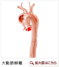 大動脈瘤　イメージ
