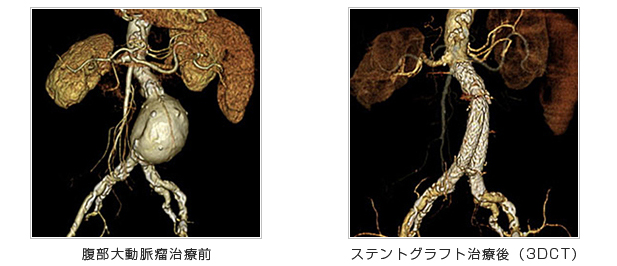 腹部大動脈瘤治療前　ステントグラフト治療後（3DCT）