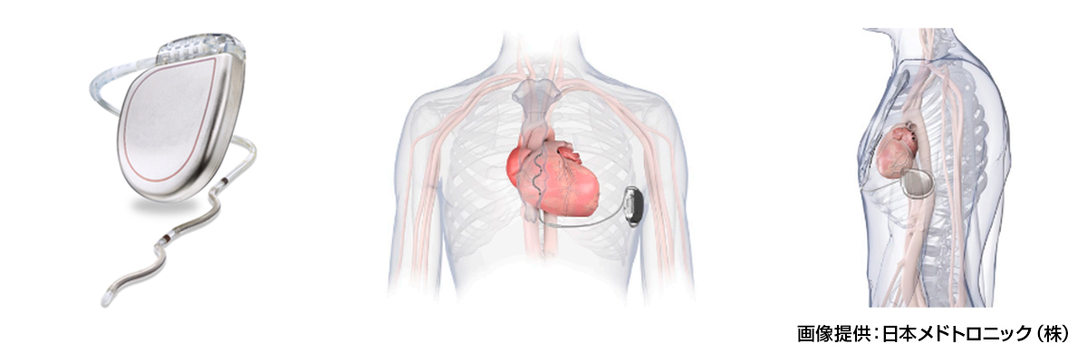 EV-ICD